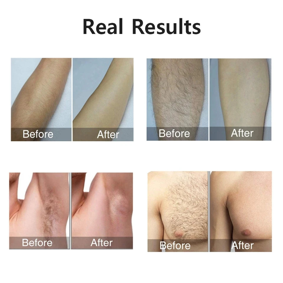 Portable IPL Laser Epilator