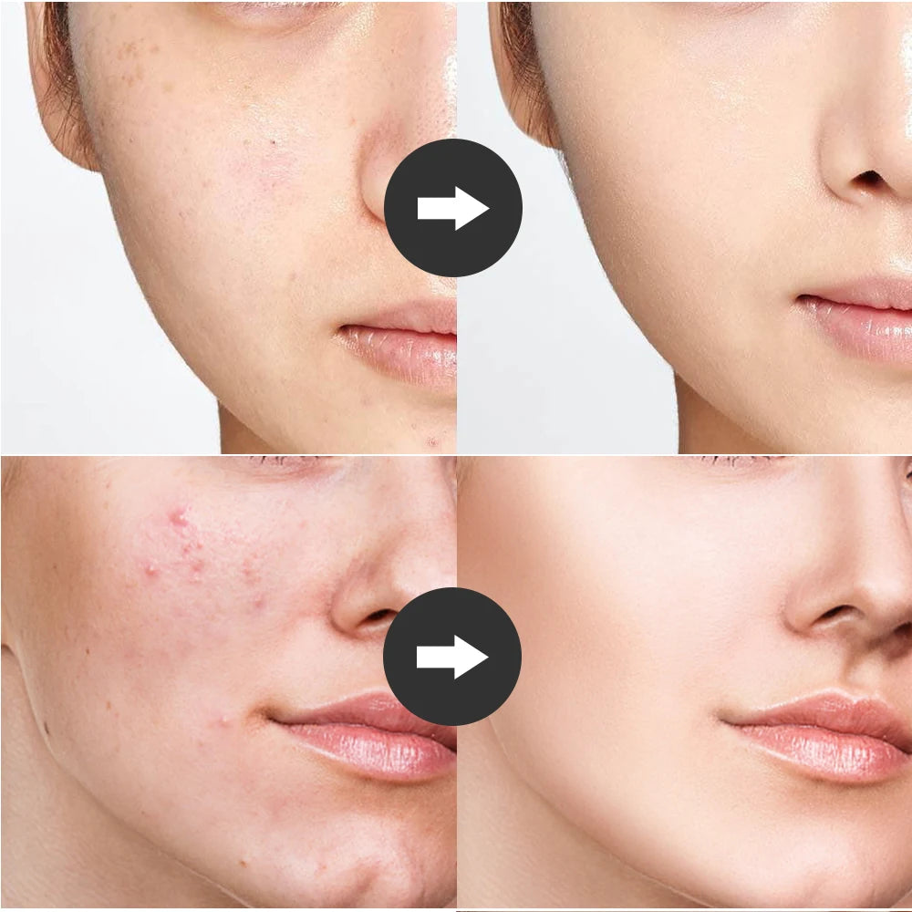 4-in-1 Portable High Frequency Facial Device